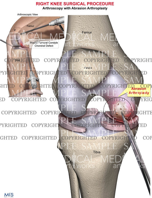 Right knee surgery of femoral condyle with microfracture pick