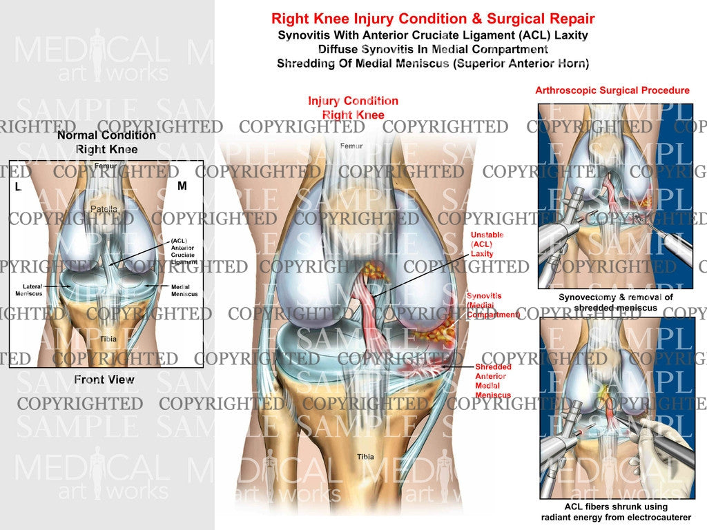 Right knee arthroscopic surgical procedure of synovitis, ACL laxity and medial meniscus