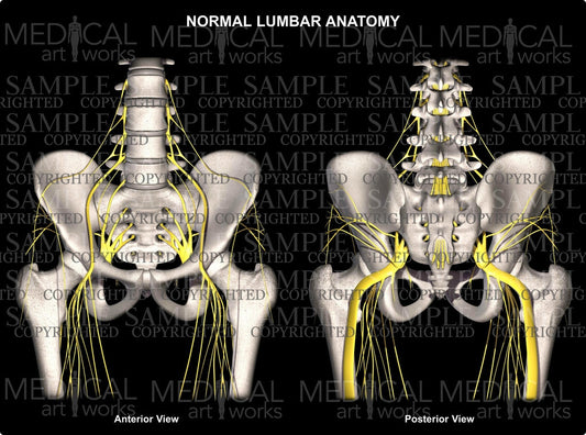 Lumbar Spine 3 level herniations