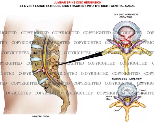 L4-5 Lumbar Spine Disc Herniation