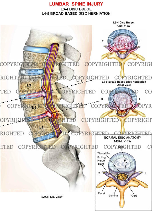 Lumbar Spine injury