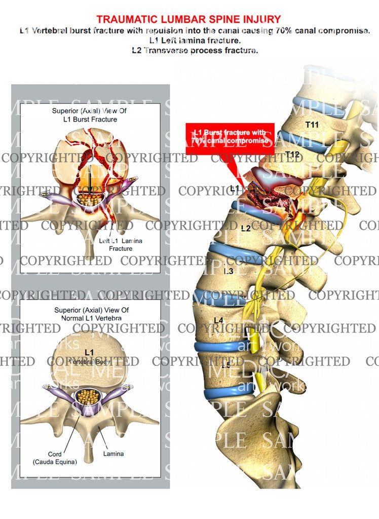 L1 Lumbar spine fracture – Medical Art Works
