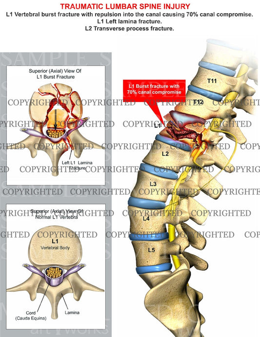 Traumatic L1 Burst fracture with canal compromise