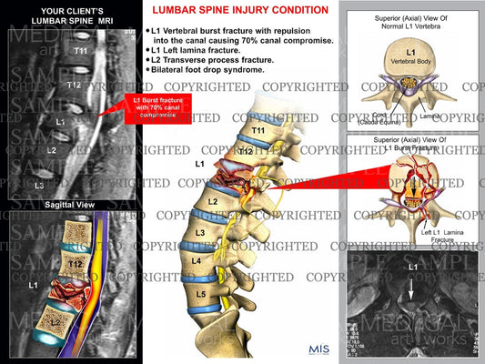 Lumbar spine fracture with MRI