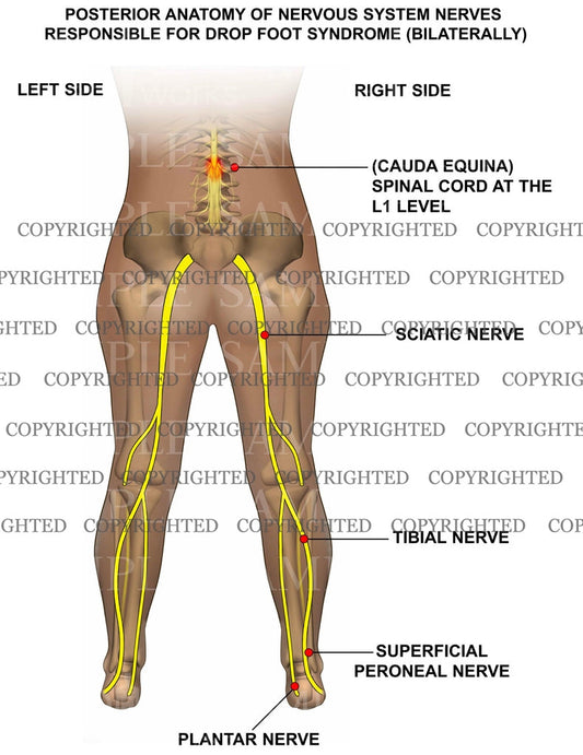 Lumbar nerves / foot drop