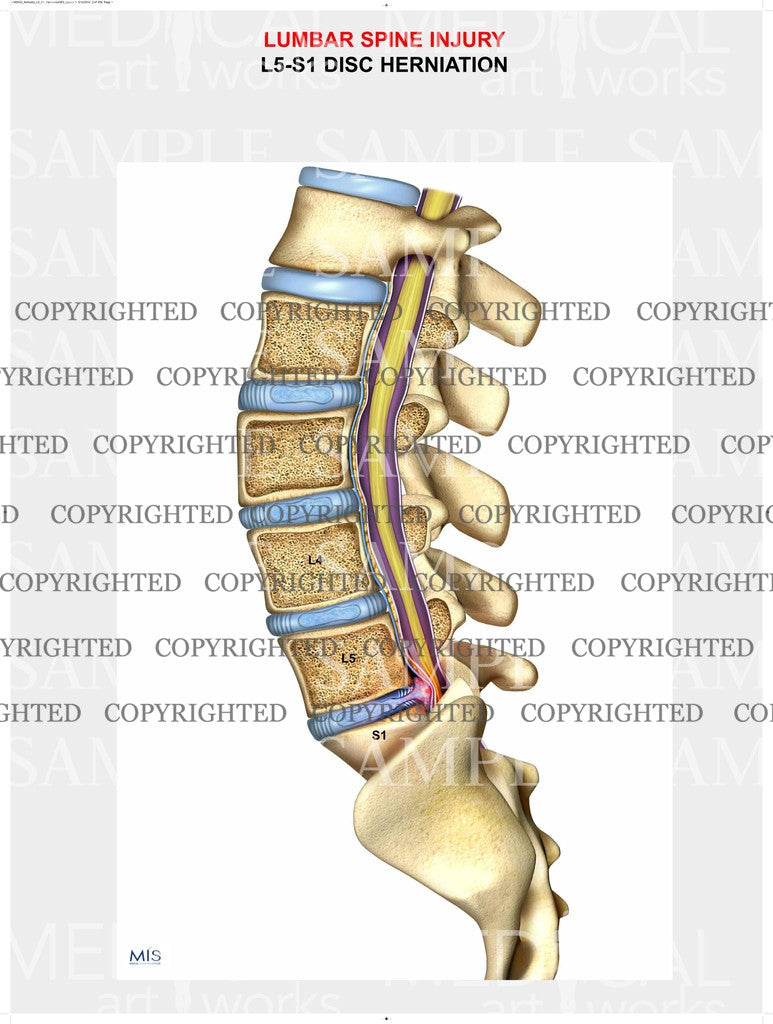 1 Level - L5-S1 Lumbar spine disc herniations