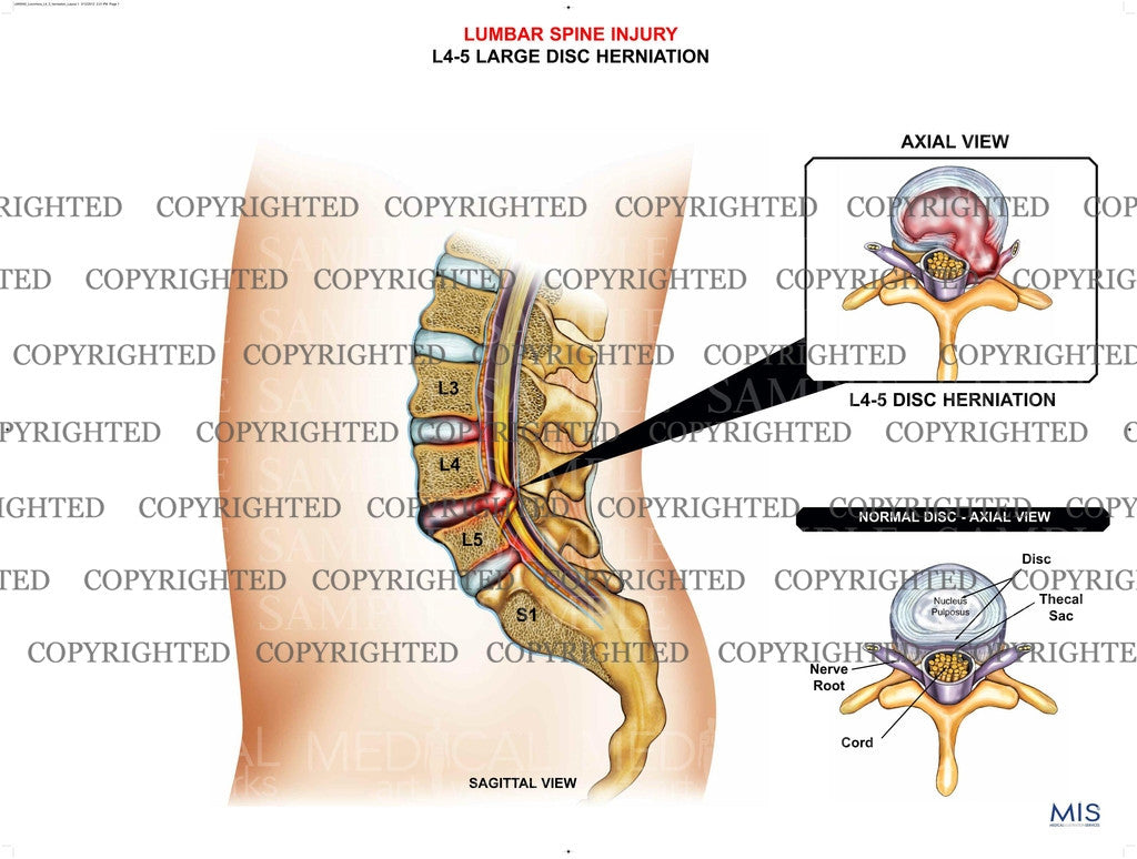 Lumbar spine large herniation