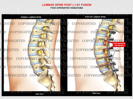 Lumbar Spine post-operative hematoma