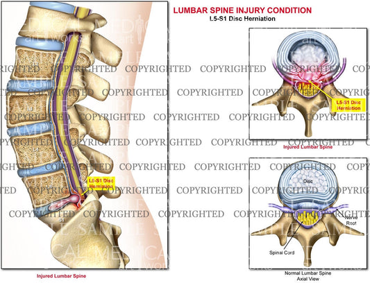 L5-S1 - Lumbar Spine Herniation