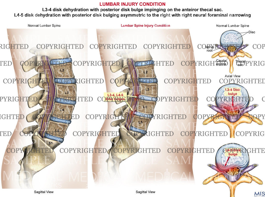 Lumbar spine disk bulges