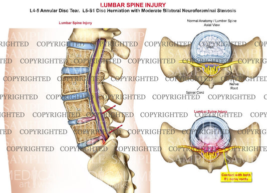 Lumbar Spine Injury - Disc herniation and stenosis