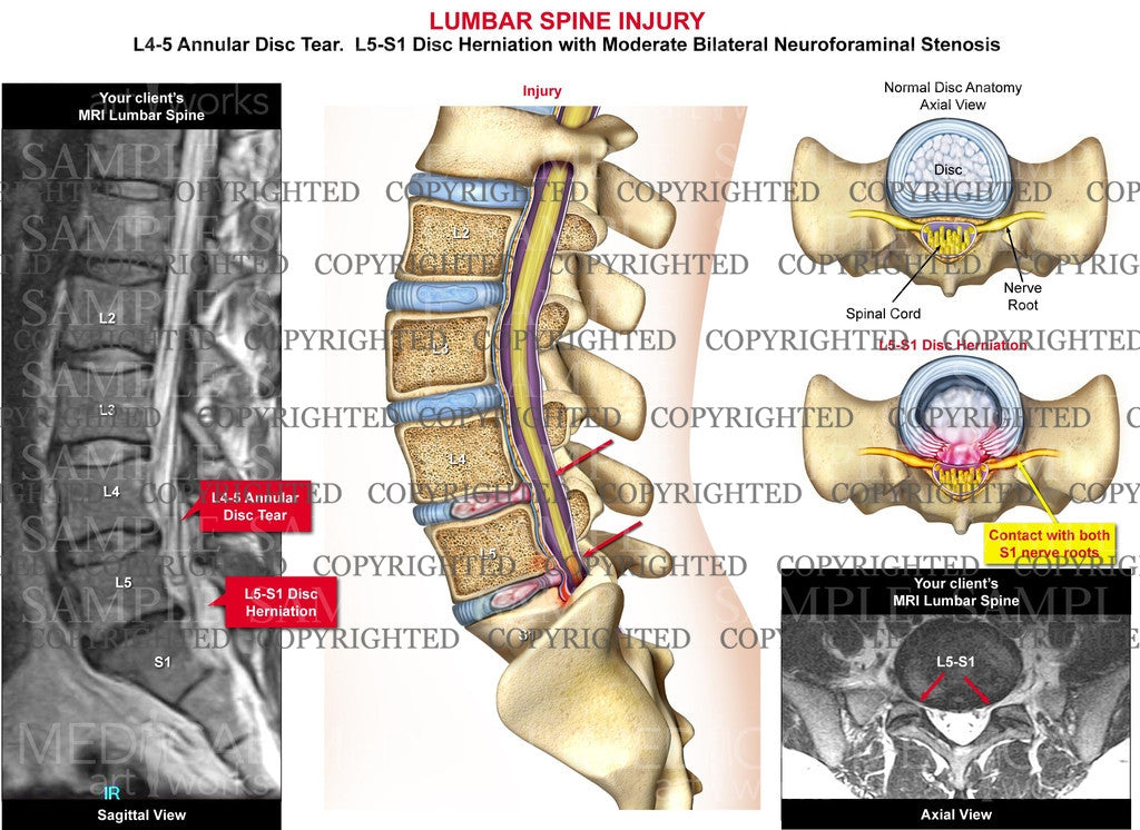 Lumbar Spine Injury 2