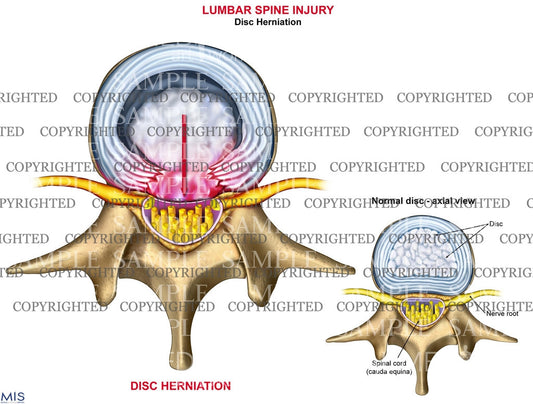 Lumbar standard disc herniation