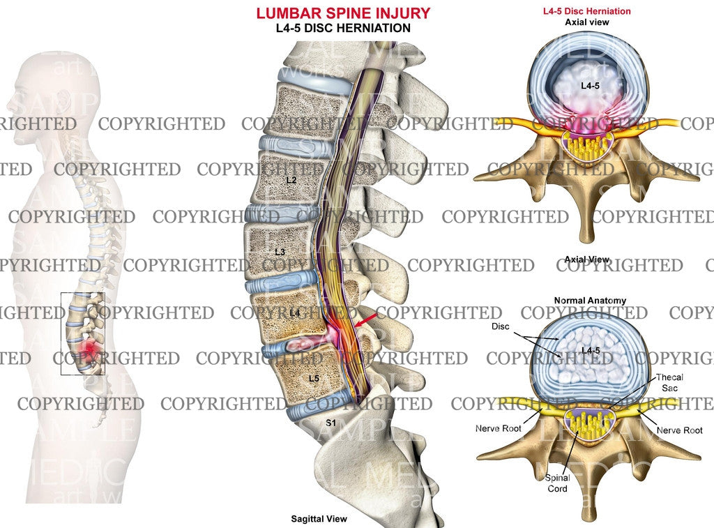 L4-5 Lumbar spine disc herniation - Male