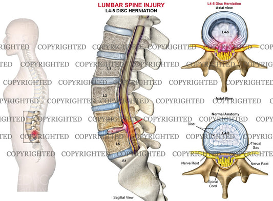L4-5 Lumbar Spine Disc Herniation - female
