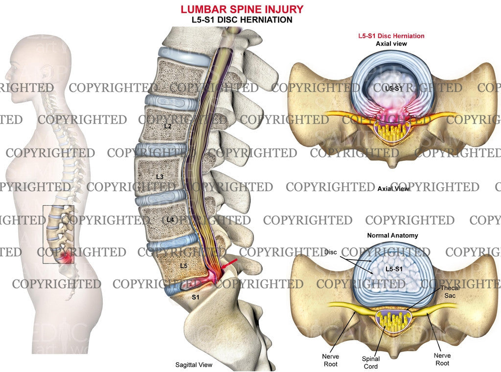 L5-S1 Lumbar spine disc herniation - Female