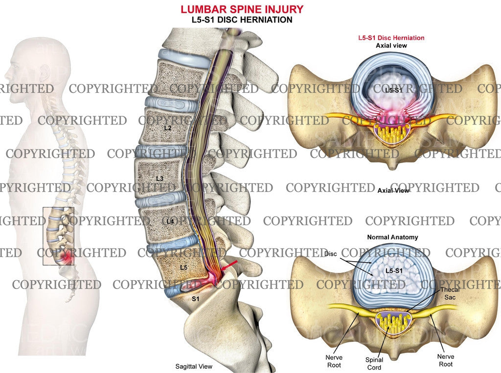 Lumbar spine disc herniation L5-S1 - male