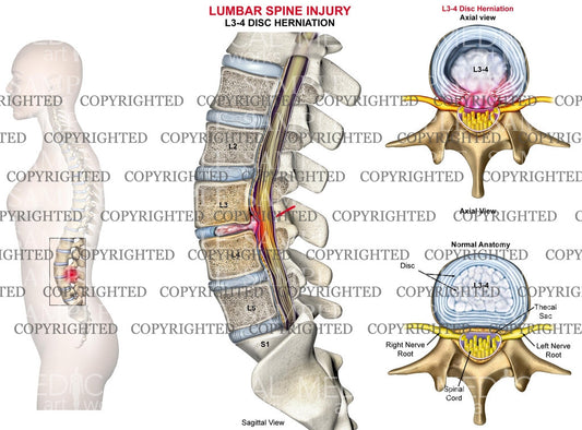 L3-4 Lumbar spine disc herniation - Female