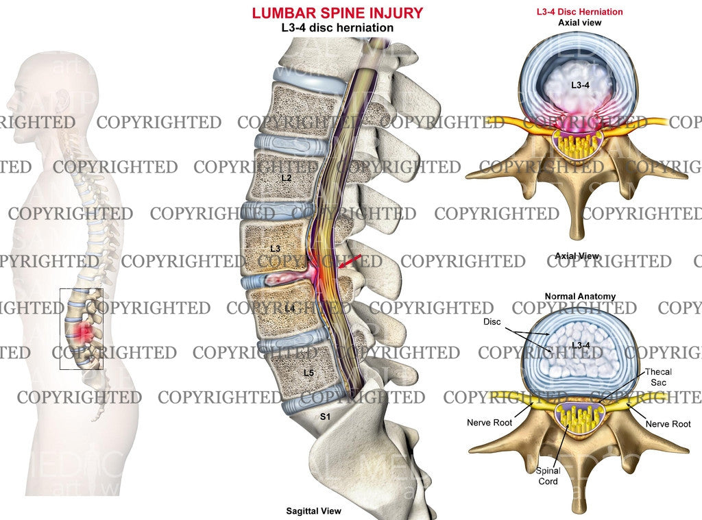 L3-4 Lumbar spine disc herniation - Male