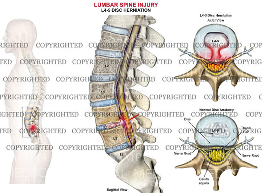Lumbar Spine standard disc herniation at L4-5