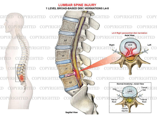 1 Level - L4-5  Lumbar spine right paracentral disc herniation