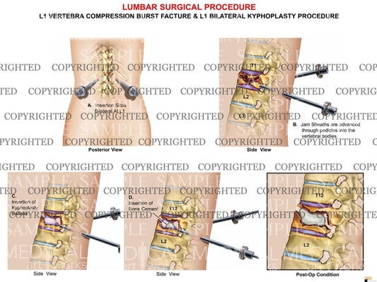 Bilateral Kyphoplasty Procedure