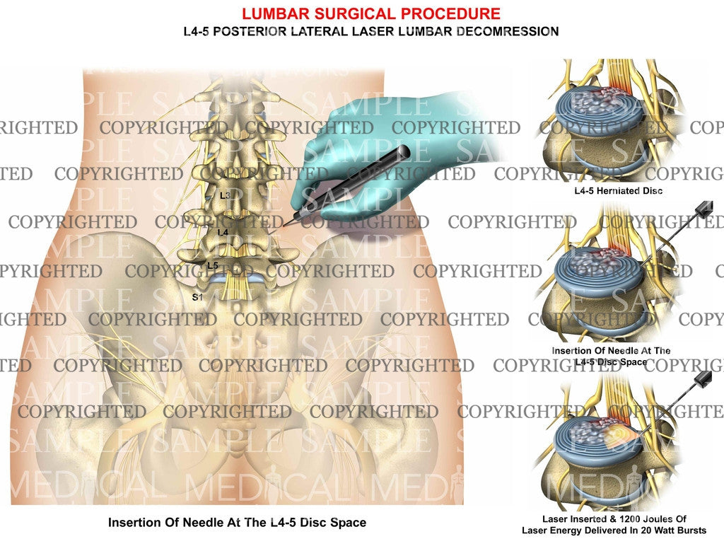 L4-5 Laser lumbar decompression