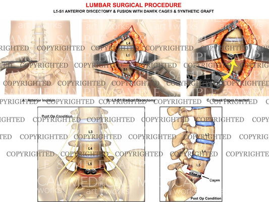 1 Level - Lumbar anterior surgical procedure