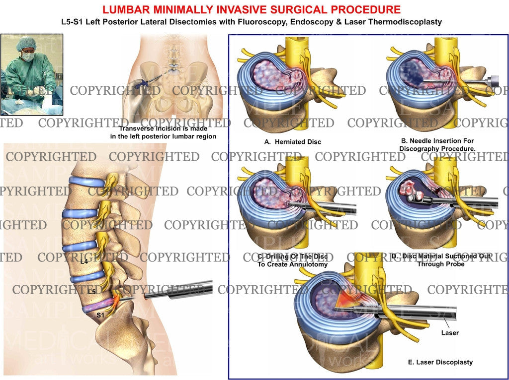 L5-S1 Lumbar spine minimally invasive fluoroscopy procedure