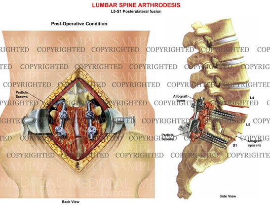 1 level - Lumbar spine posterolateral arthrodesis