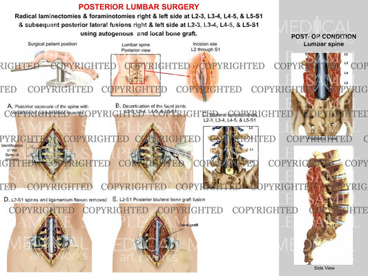 Posterior lumbar spine decompression