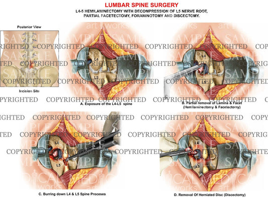 L4-5 Posterior lumbar surgical procedure