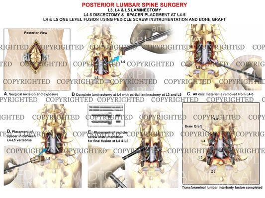 2 level - L3, L4 & L5 Laminectomy + Discectomy + L4-5 fusion