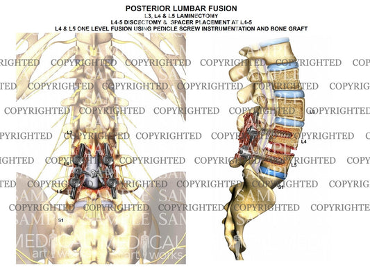 2 level - L3-5 posterior laminectomy and fusion
