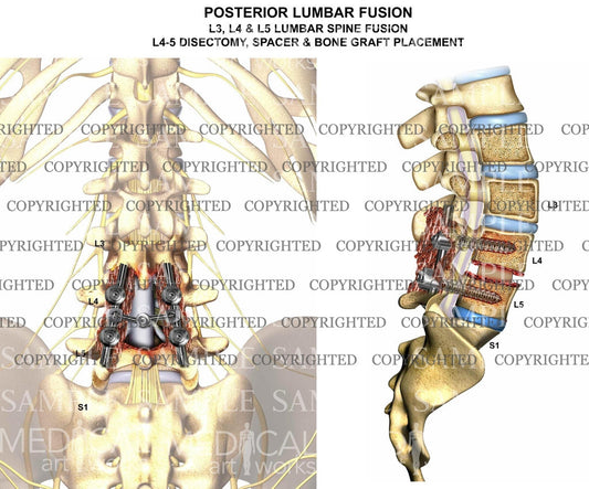 1 level - Lumbar spine interbody fusion with instrumentation.