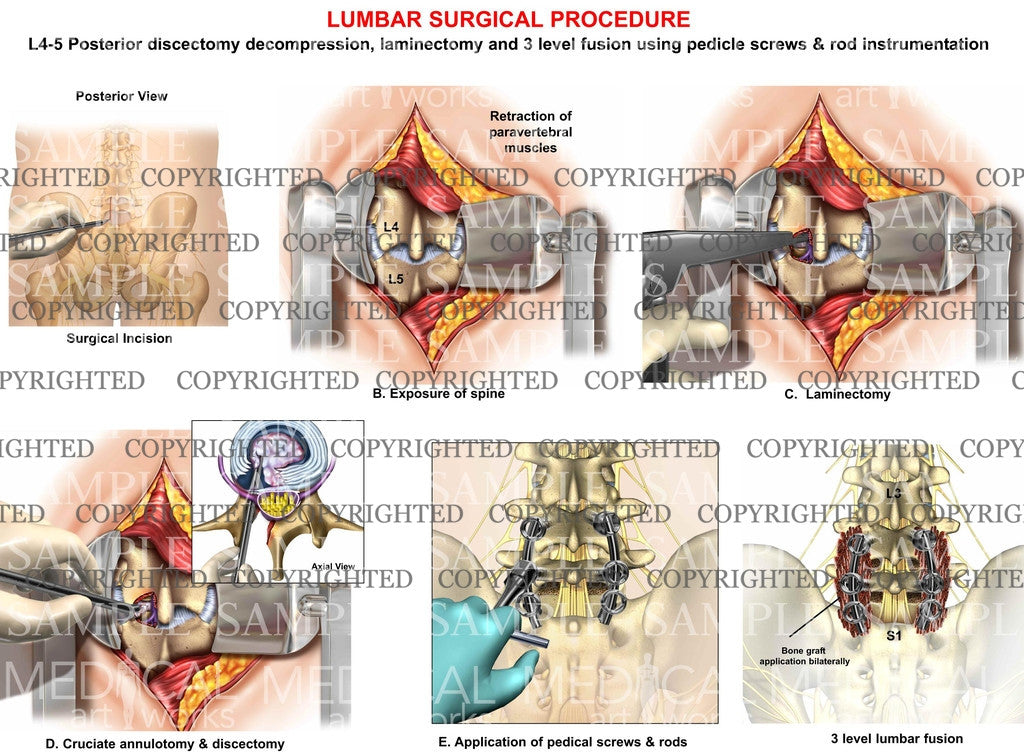 Lumbar posterior surgery