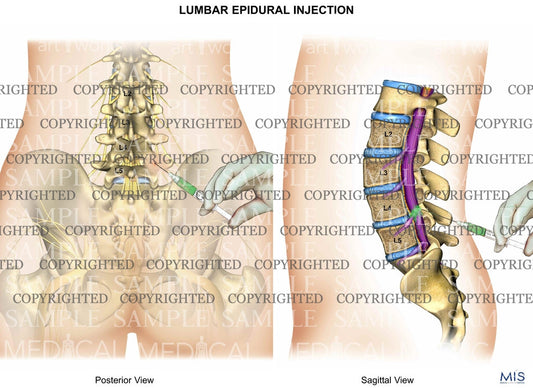 Lumbar epidural steroid injection under fluoroscopy