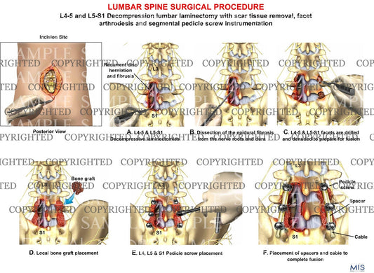 1 Level - Posterior Lumbar interbody fusion with laminectomy