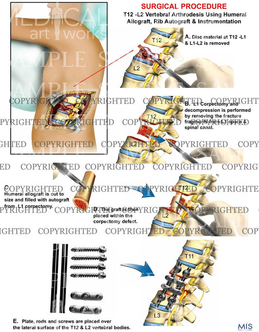 T12 -L2 Vertebral Arthrodesis