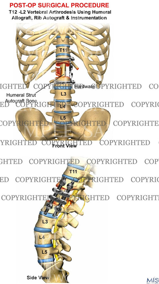 T12 -L2 Vertebral Arthrodesis post-op