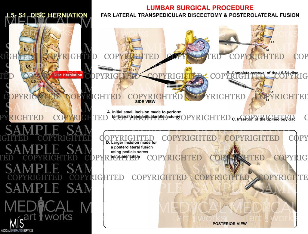 Lumbar surgical procedure on L5-S1