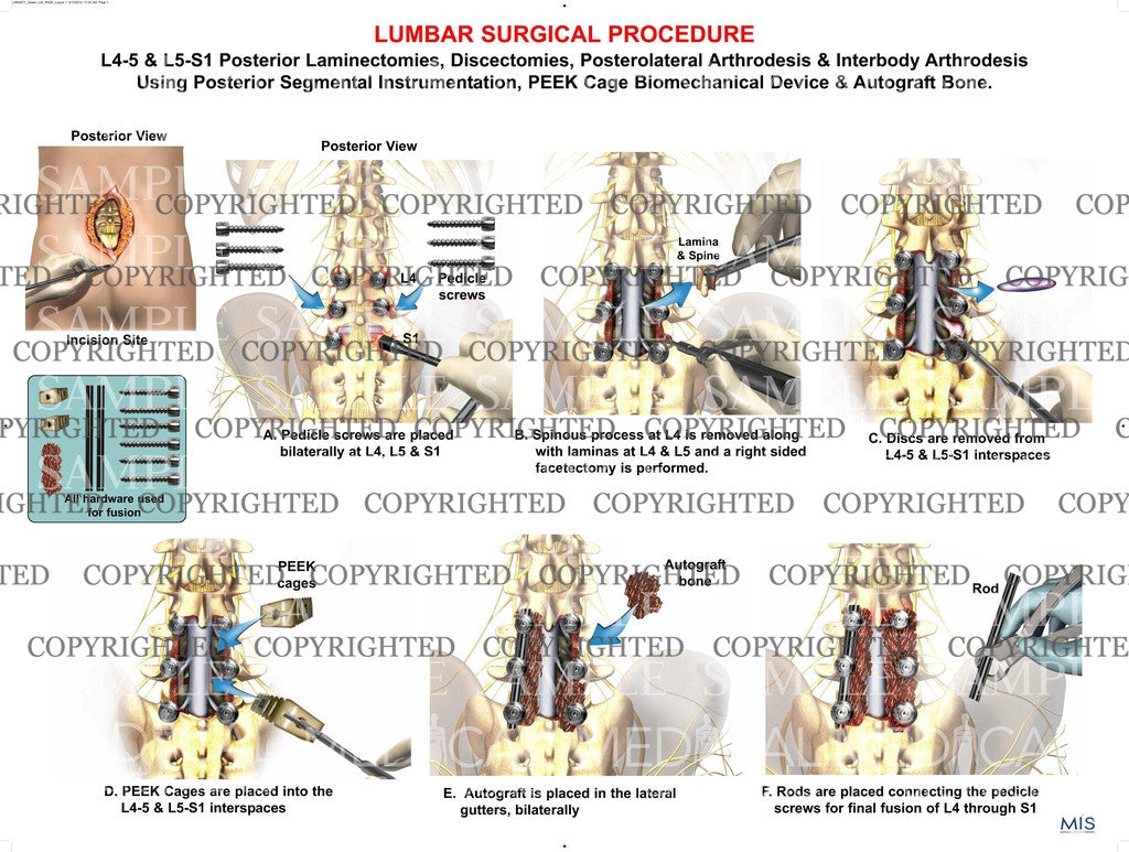 1 Level - Anterior Lumbar surgical procedure