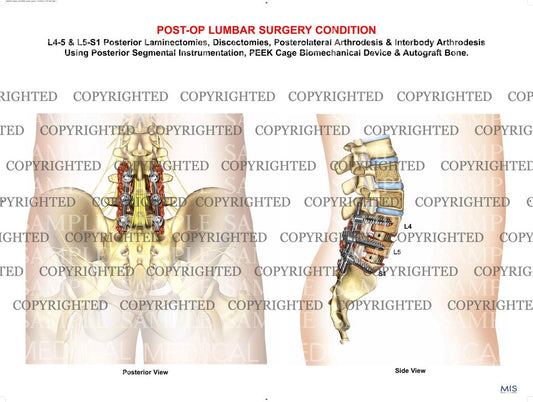 Lumbar surgical procedure post-op