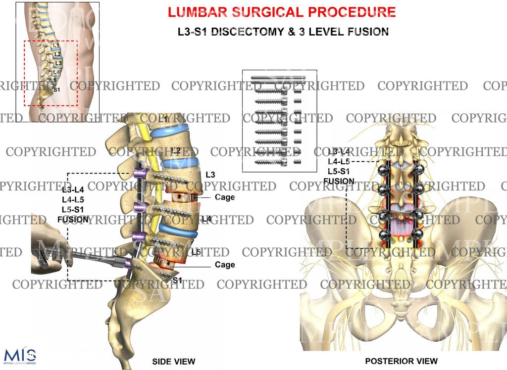 3 Level - Posterior lumbar interbody fusion surgery