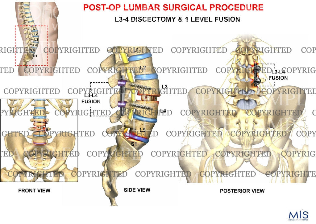 Post operative lumbar surgical procedure 2
