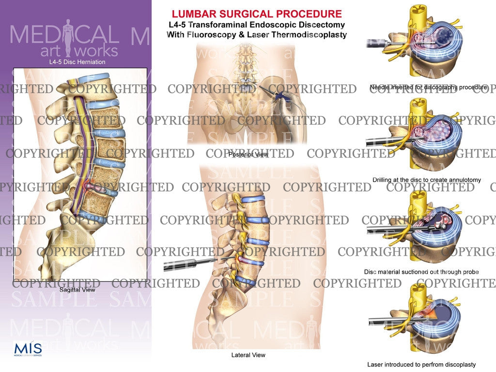Lumbar surgical procedure