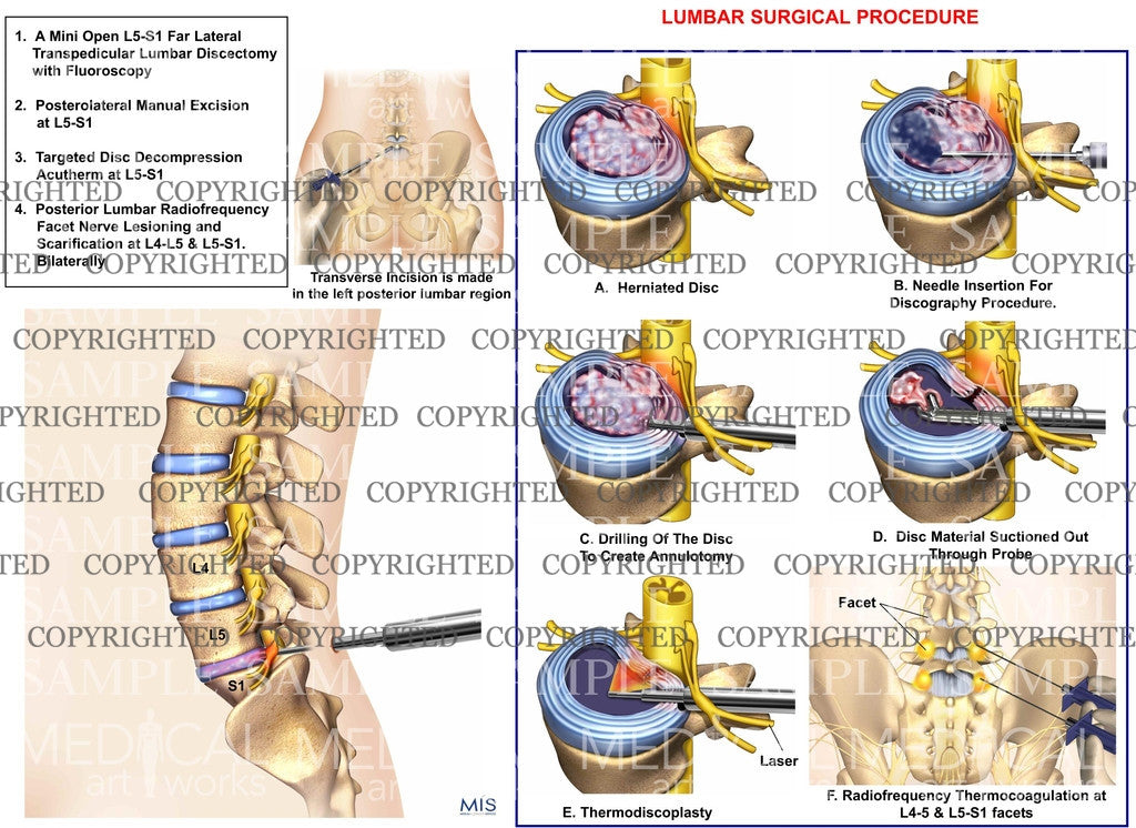 minimal invasive lumbar surgical procdure