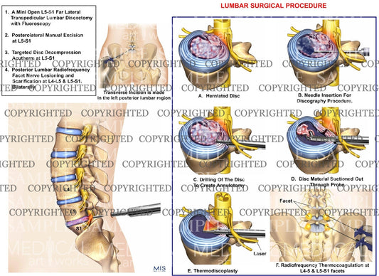 minimal invasive lumbar surgical procdure