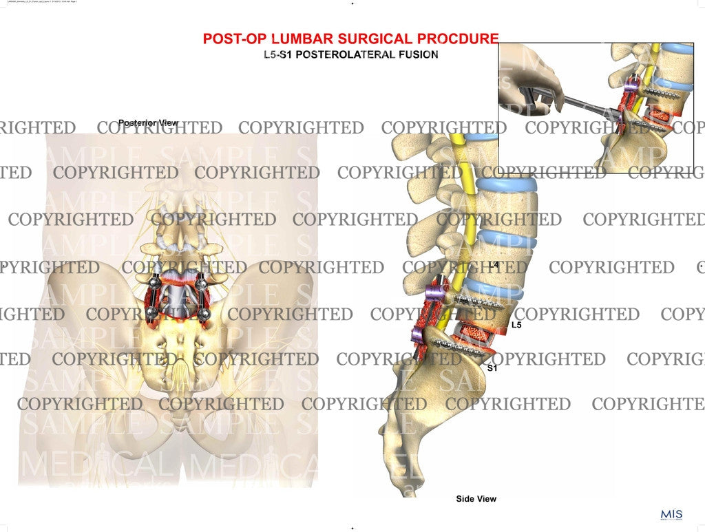 1 level - Post  operative lumbar surgical procdure