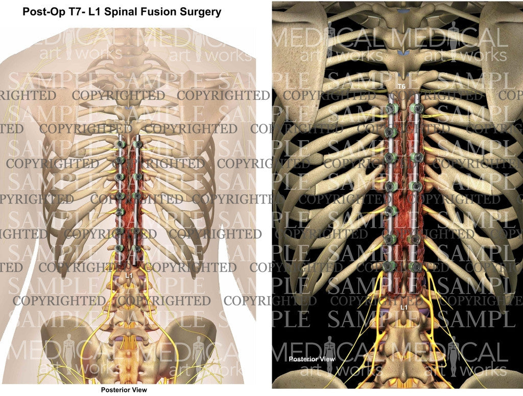 Posterolateral Spinal Fusion post operative